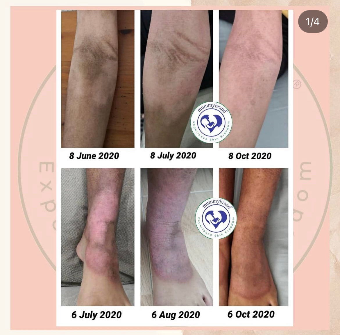 Z-Advanced Moisturiser - For Itchy & Discomfort Skin (200g)