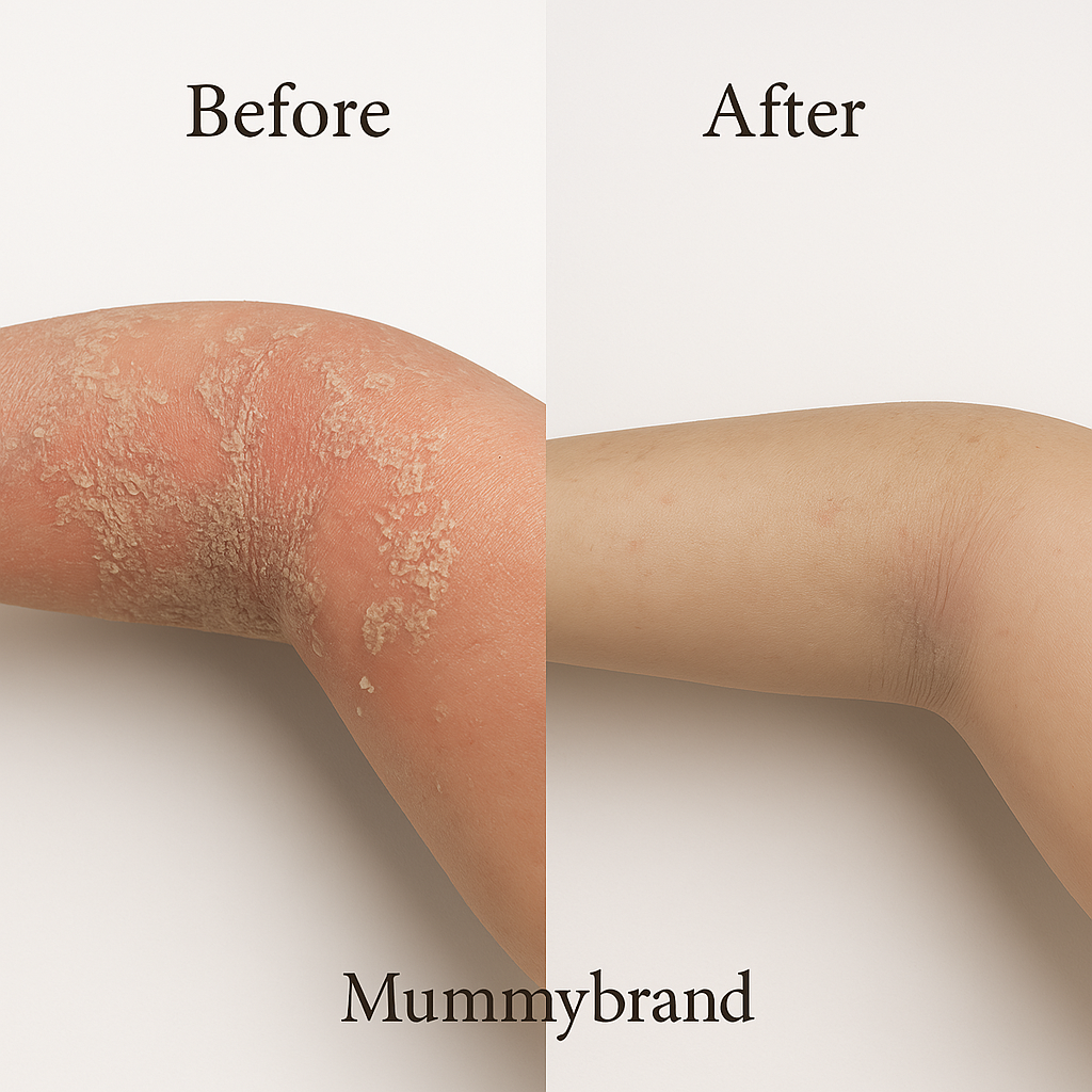 [Mid May 2025] Z-Advanced Moisturiser - For Itchy & Discomfort Skin (200g)