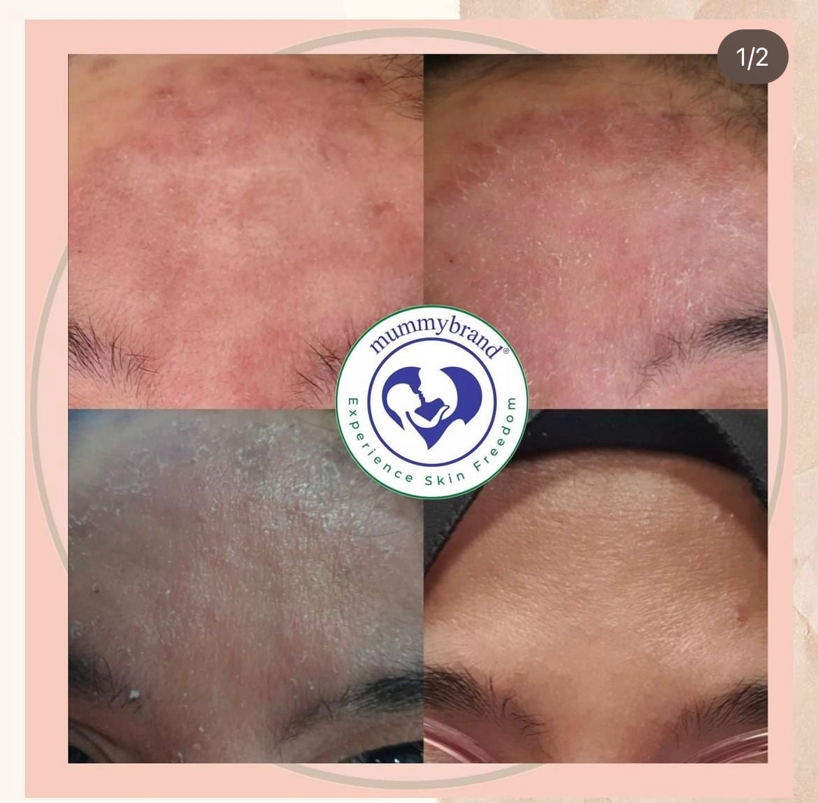 [MID MAY 2025] Z-Advanced Pro Jelly For Chronic Sensitive Skin (120g)