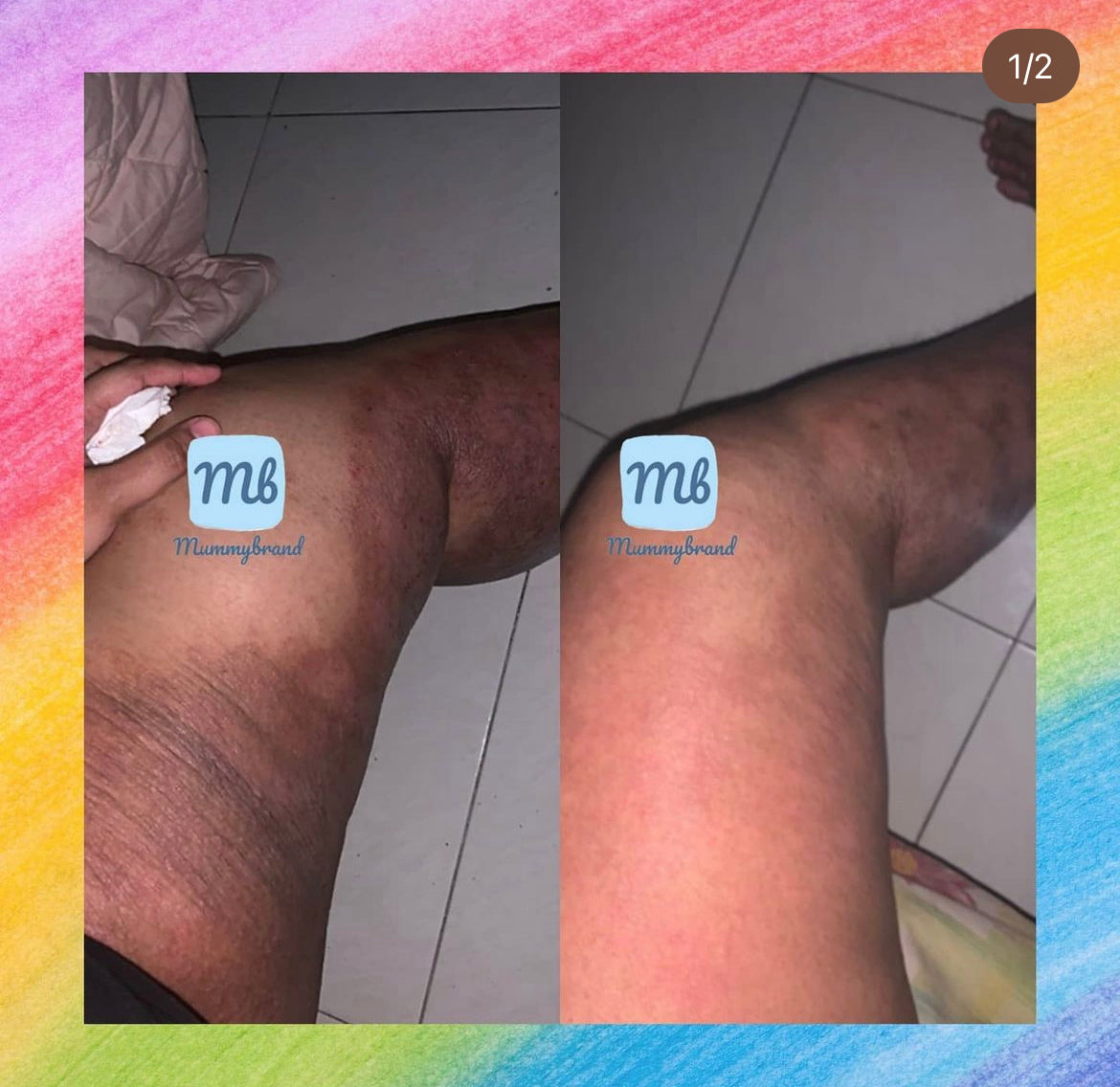 [MID MAY 2025] Z-Advanced Pro Jelly For Chronic Sensitive Skin (120g)