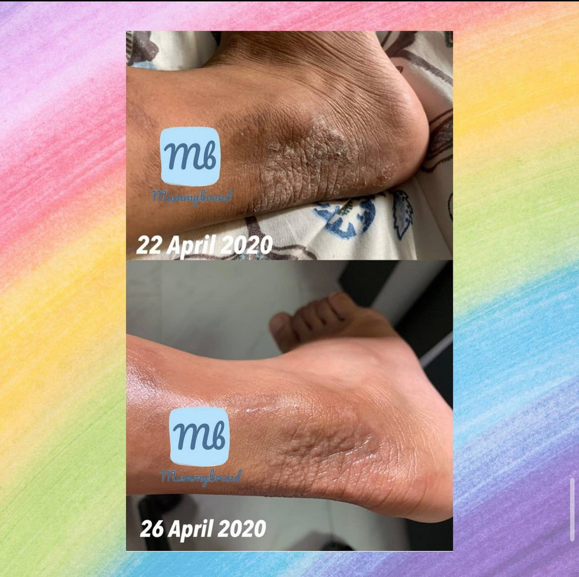 [MID MAY 2025] Z-Advanced Pro Jelly For Chronic Sensitive Skin (120g)
