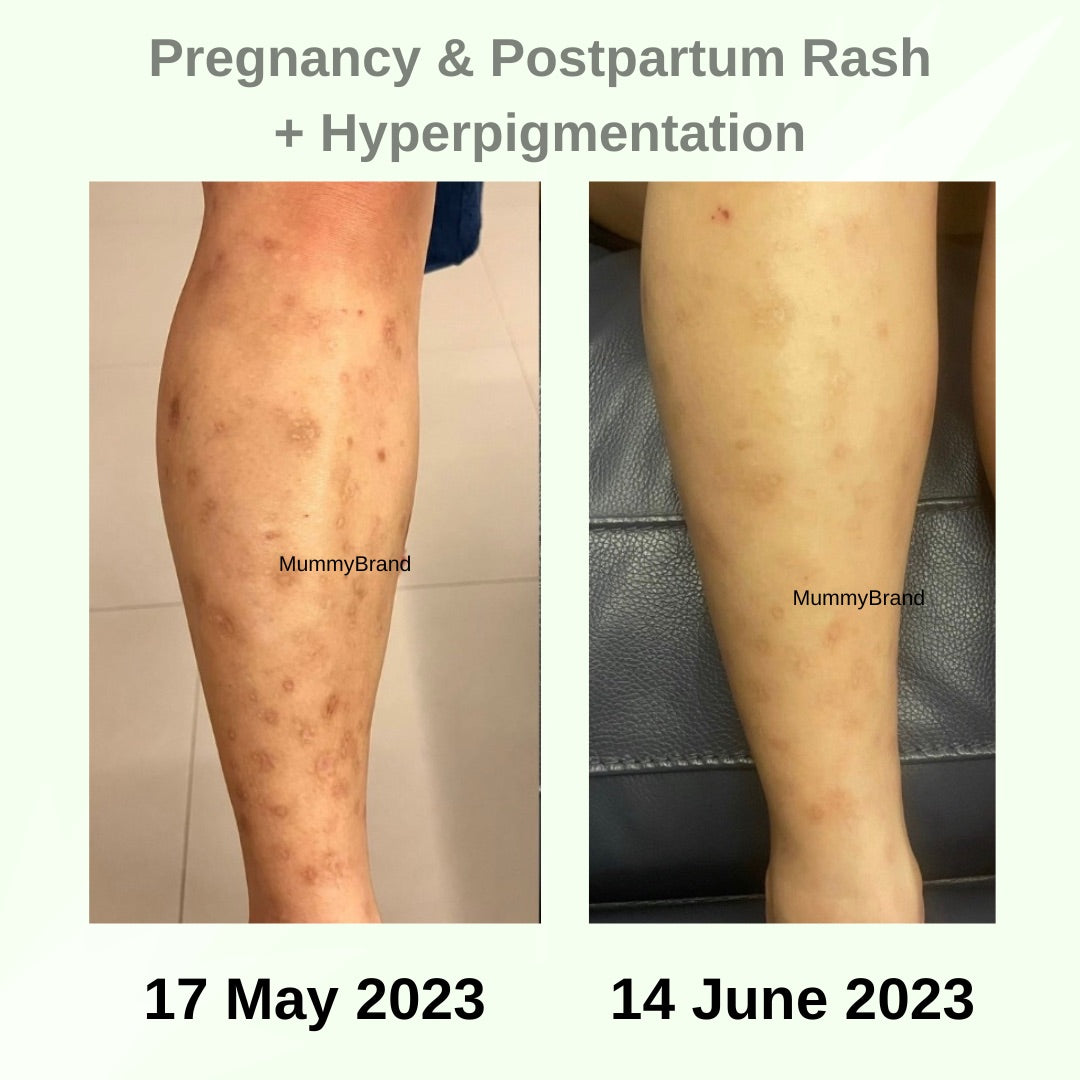 [PREORDER: Mid May 2025] Z-Advanced Moisturiser - For Itchy & Discomfort Skin (200g)