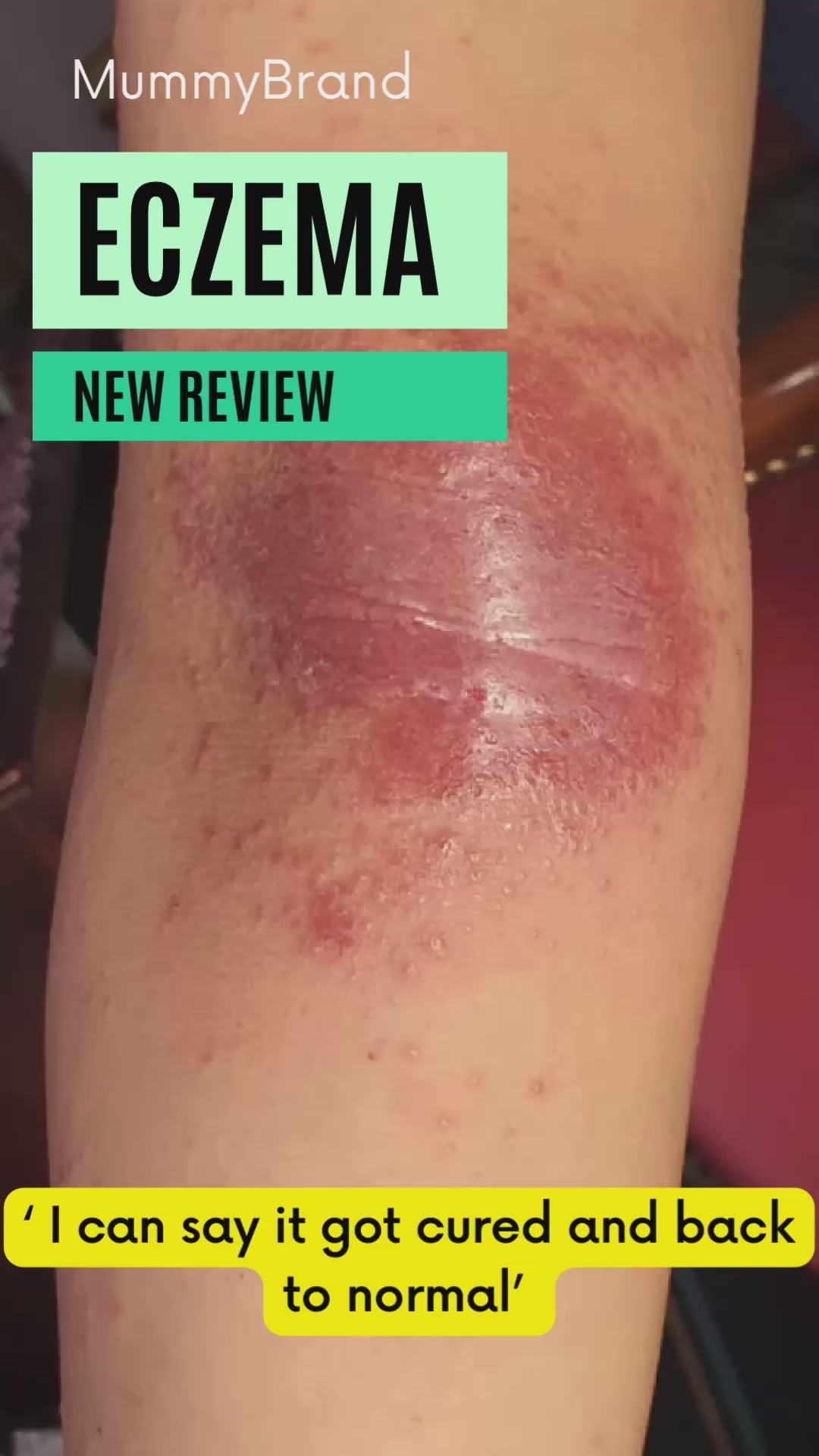 [MID MAY 2025] Z-Advanced Pro Jelly For Chronic Sensitive Skin (120g)